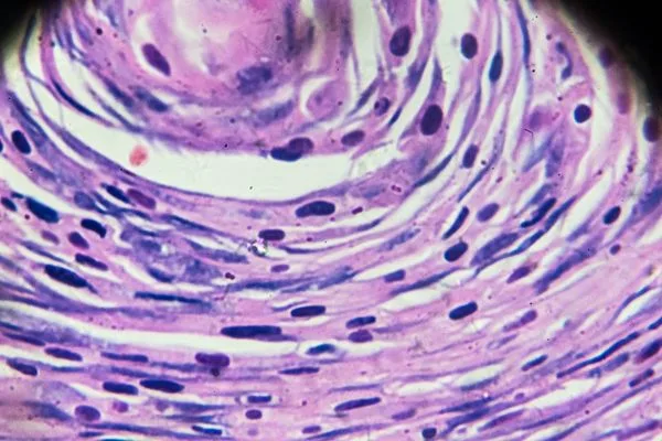 lesiones precancerosas y cancerosas